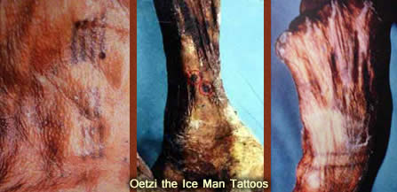 The tattoos of Oetzi the iceman